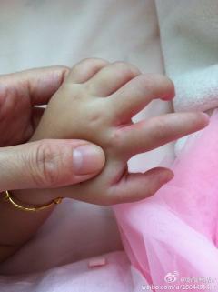 不知道是什么昨天发现我女儿手指缝里有类似湿疹一样的颗粒