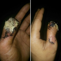 左手大拇指伤残图片图片