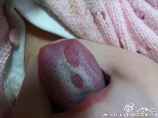 宝宝舌苔霉菌感染图片图片