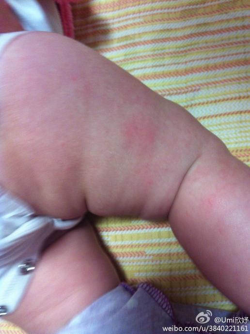 宝宝奶粉过敏症状图片图片