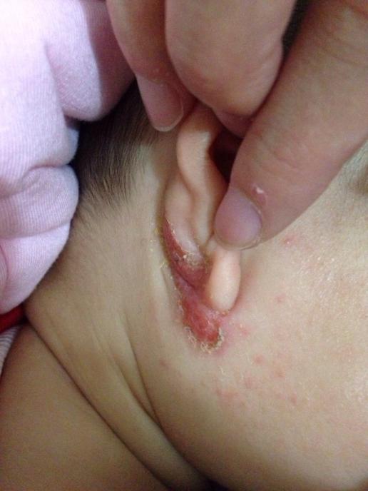 新生儿外耳道湿疹图片