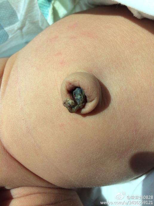 40天婴儿肚脐疝图片图片