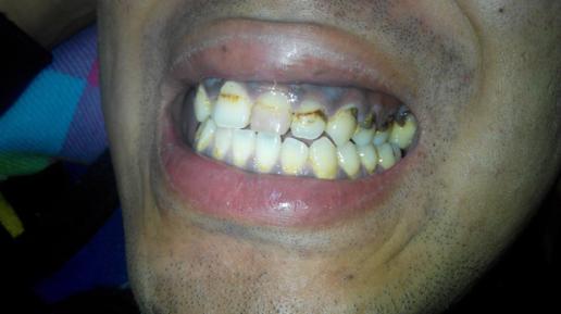 牙龈发紫发黑是什么情况? 而且从牙齿根部开始坏掉 ,本人抽烟,年龄30