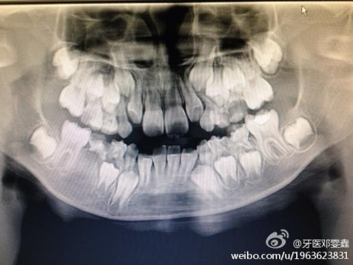 上顯示右下五恆牙胚缺失的,但是右下第二乳磨牙的牙根為什麼會吸收