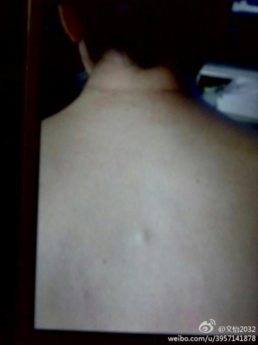 肩胛骨脂肪瘤图片