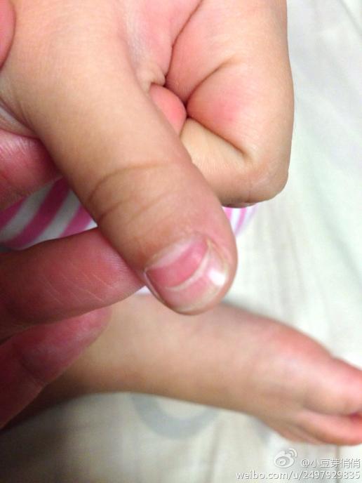 宝宝手指甲分层图片
