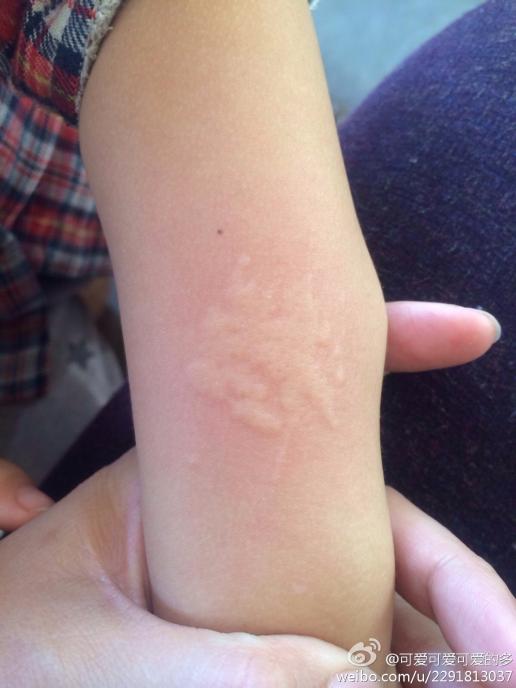 您好孩子三岁,这两天发烧可伴随着四肢起这种疹子,请问这是过敏吗?