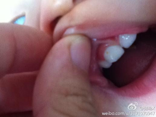 孩子一岁八个月 牙齿上有个黄色的点 有点凹陷 是什么原因 谢谢