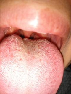 舌头靠近喉咙处有泡泡图片