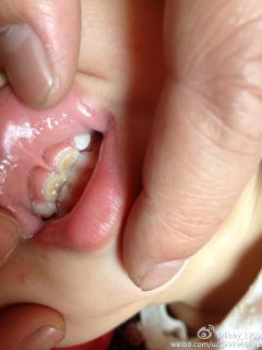 请问宝宝牙齿这样是牙釉质发育不良还是蛀牙