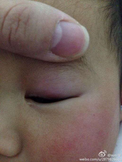 8个月宝宝结膜炎图片图片