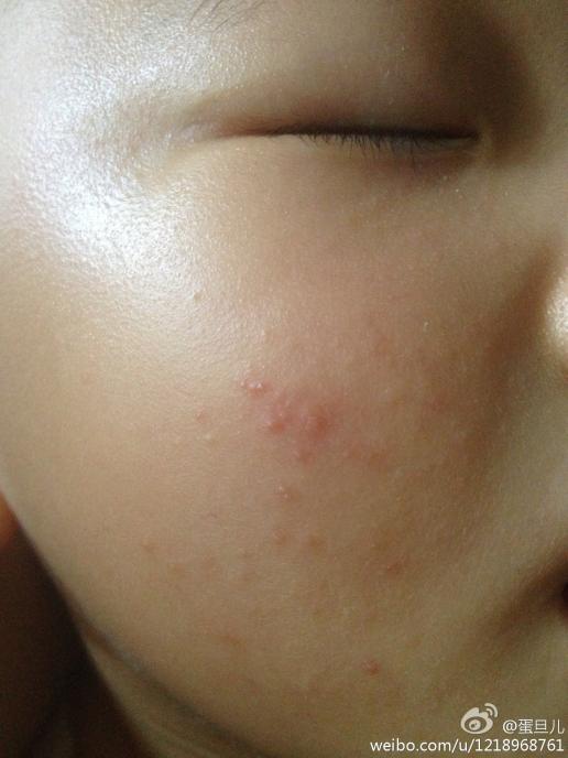 我家宝宝脸上最近一直有这种小红点,两个脸蛋上都有,是因为天气太热的
