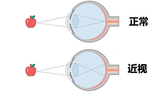 近視改變了眼球結構,
