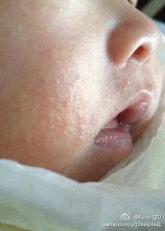 宝宝脸上奶疹子图片图片
