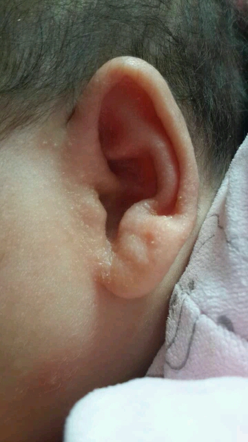 婴儿耳朵有黄粘液图片